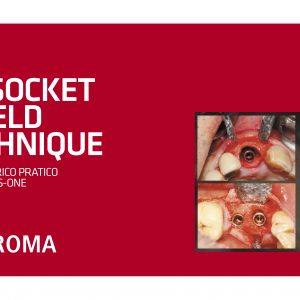 LA SOCKET SHIELD TECHNIQUE